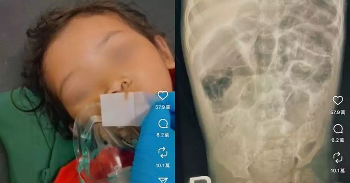 印尼女童昏迷送醫鼻孔爬出蛔蟲  糞便檢出逾1KG蟲體 確診腦膜炎10日後不治