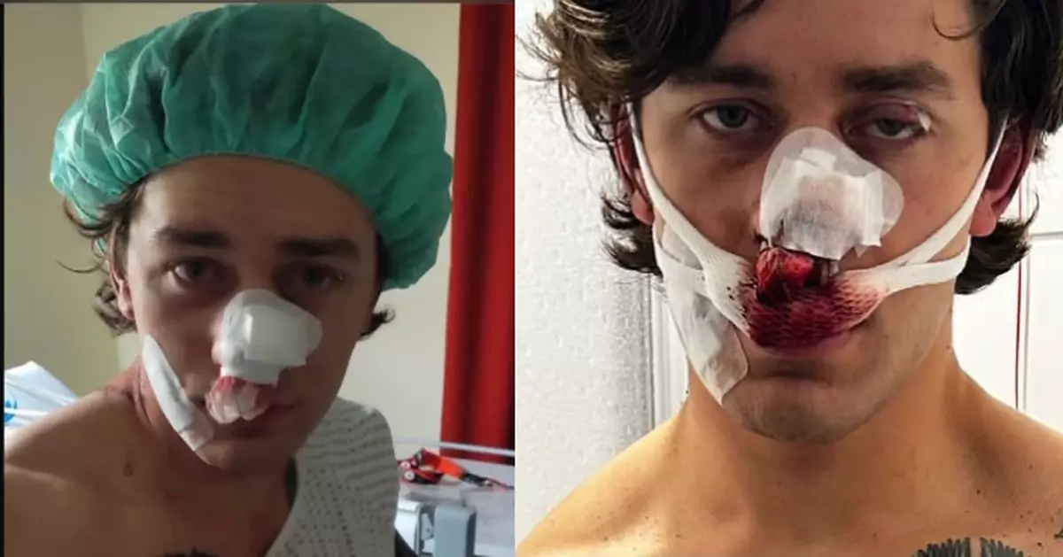 美帥氣男模德國搭電車勇救2被騷擾女乘客 面部遭劃15CM長傷口毀容