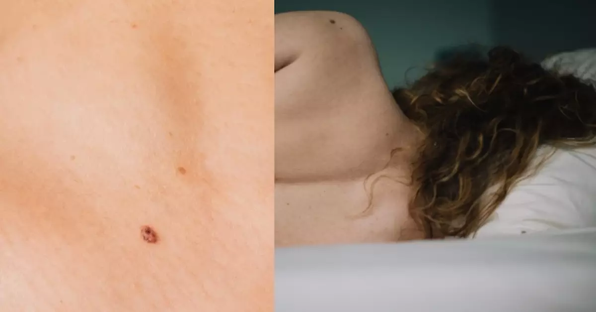身體6部位長痣要留意！專家示警：或變惡性黑色素瘤