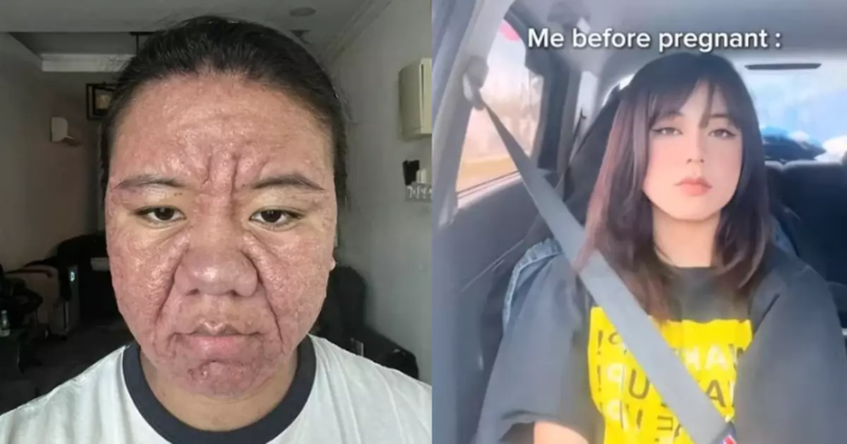 大馬孕婦荷爾蒙失衡變老皮膚佈滿膿皰 幸得丈夫陪伴左右走過孕期