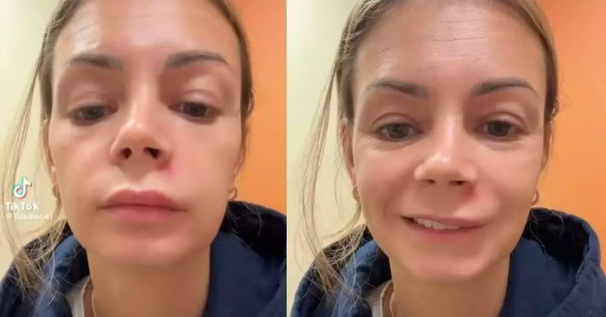 鼻孔下生囊腫暗瘡 美婦手多多擠壓致半邊臉腫脹需送醫 醫生：別碰死亡三角