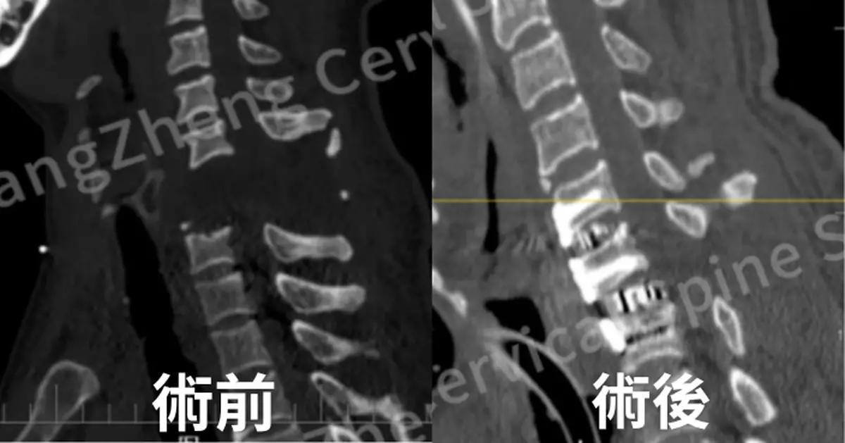 上海男頸部遭機械臂重擊 頸椎脫位近「身首分離」獲醫療團隊用創新技術救命