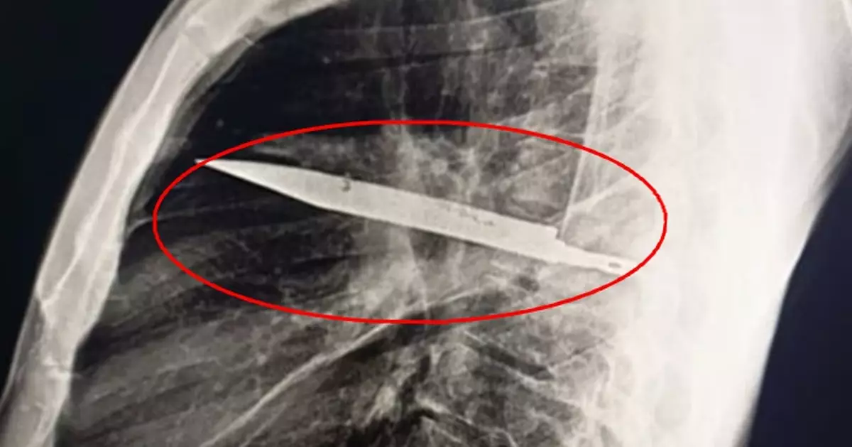 坦桑尼亞44歲男乳頭痛流膿 醫生檢查驚揭胸腔插刀8年