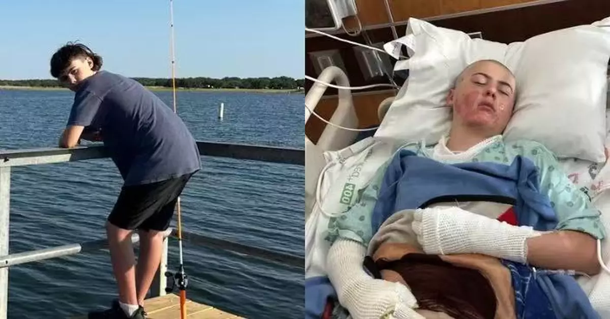 仿效TikTok「噴射火焰」挑戰 美12歲男童襯衫起火全身逾1成燒傷