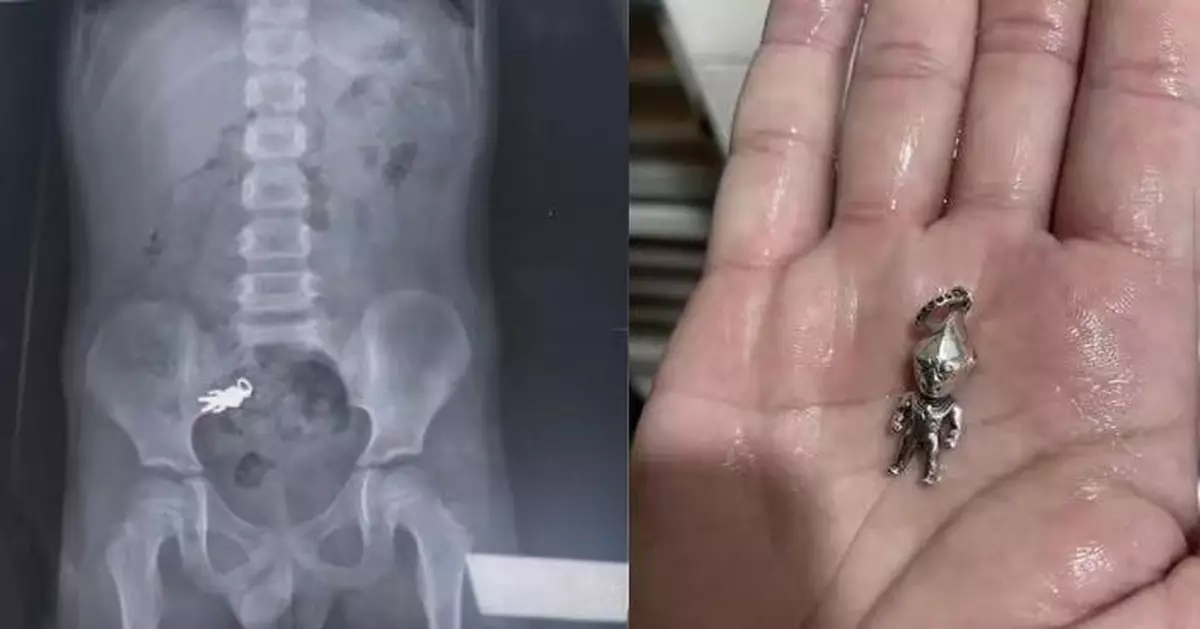 台男童食餅乾誤吞「鹹蛋超人」吊飾 照X光完整現形 後續曝光