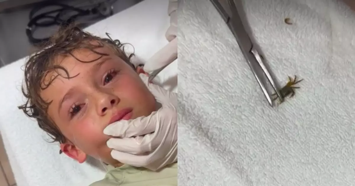 男童墨西哥海邊戲水返家突感耳朵不適就醫 醫生夾出活生生小螃蟹