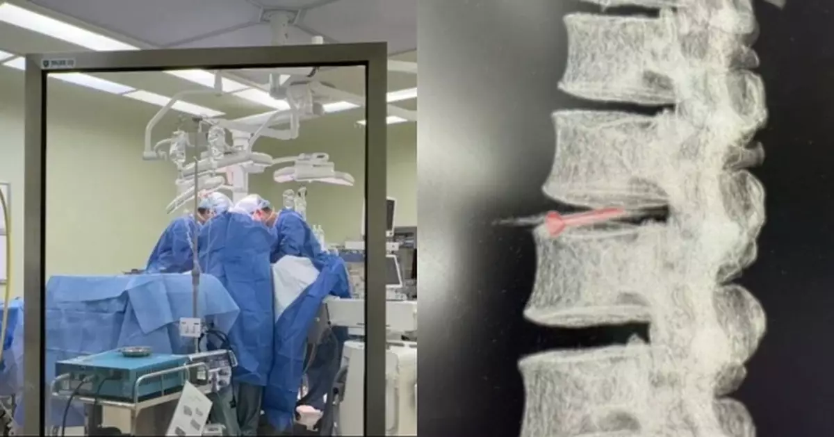 無錫裝修工遭釘槍射腹 送院揭3cm工程釘體內遊走卡腰椎間盤