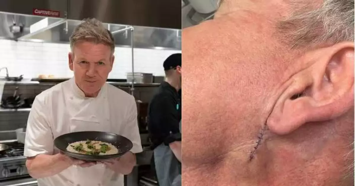 曾患皮膚癌 英「地獄廚神」抗癌成功公開術後疤痕照幽默澄清：沒做拉皮