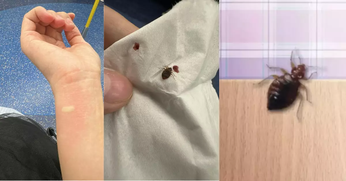 女乘客搭地鐵疑怪蟲咬中手腕紅腫出血 網民急籲：千祈唔好帶返屋企！