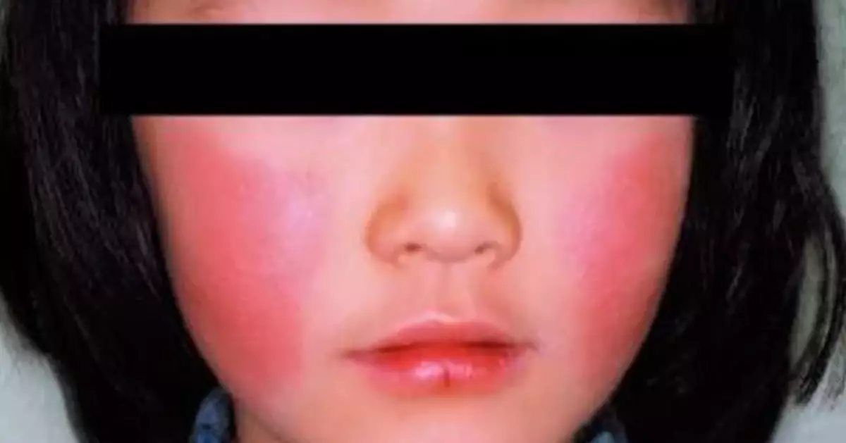 沖繩爆「蘋果病」疫情！一周急增12病例 孕婦感染恐致流產畸形