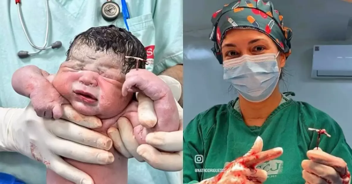 避孕成功率99%都阻唔到 巴西初生男嬰手持避孕器出生成全球焦點