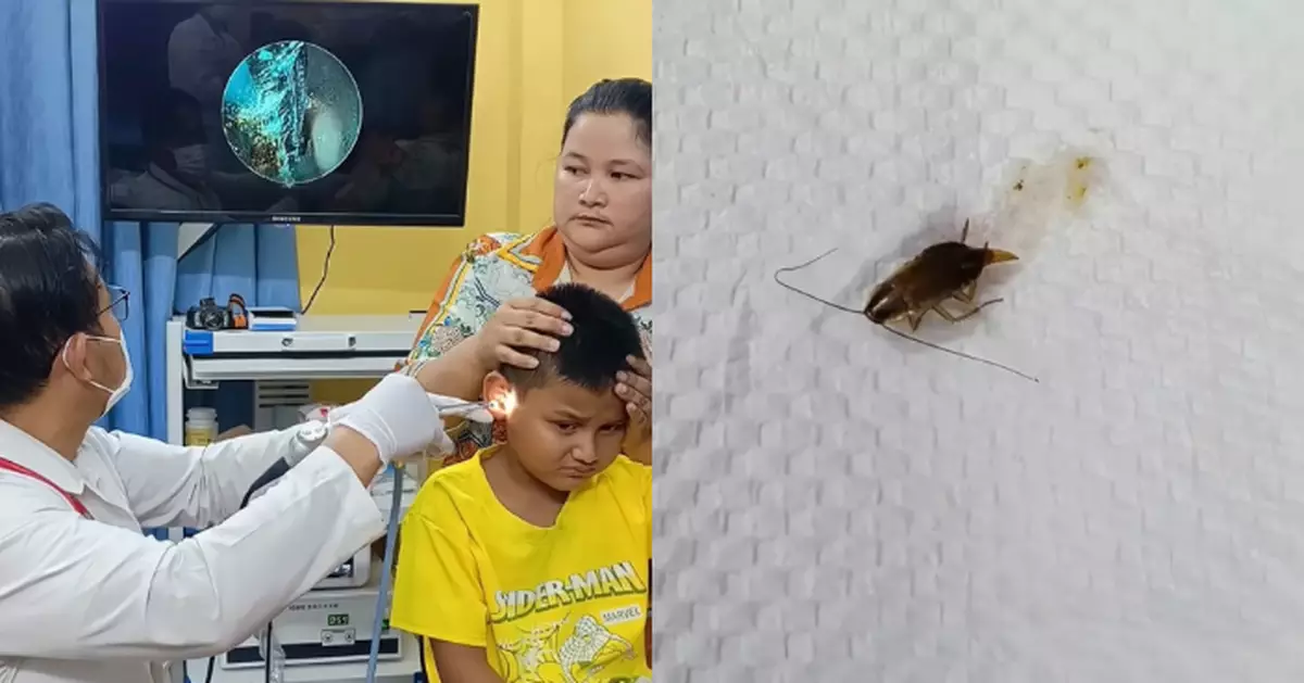 柬埔寨男童耳痛耳鳴急求醫 醫生竟從耳道深處夾出活曱甴