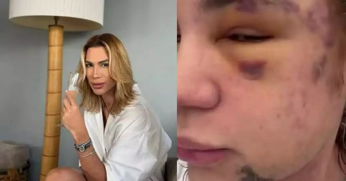 接受「狐狸眼」手術提眼角 巴西31歲網紅術後嚴重感染猝逝