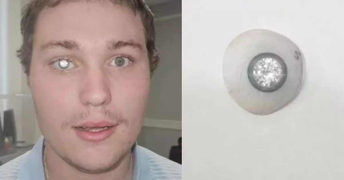 因病失右眼  美珠寶設計師豪斥逾千萬鑲2克拉真鑽製義眼 網民憂安全問題