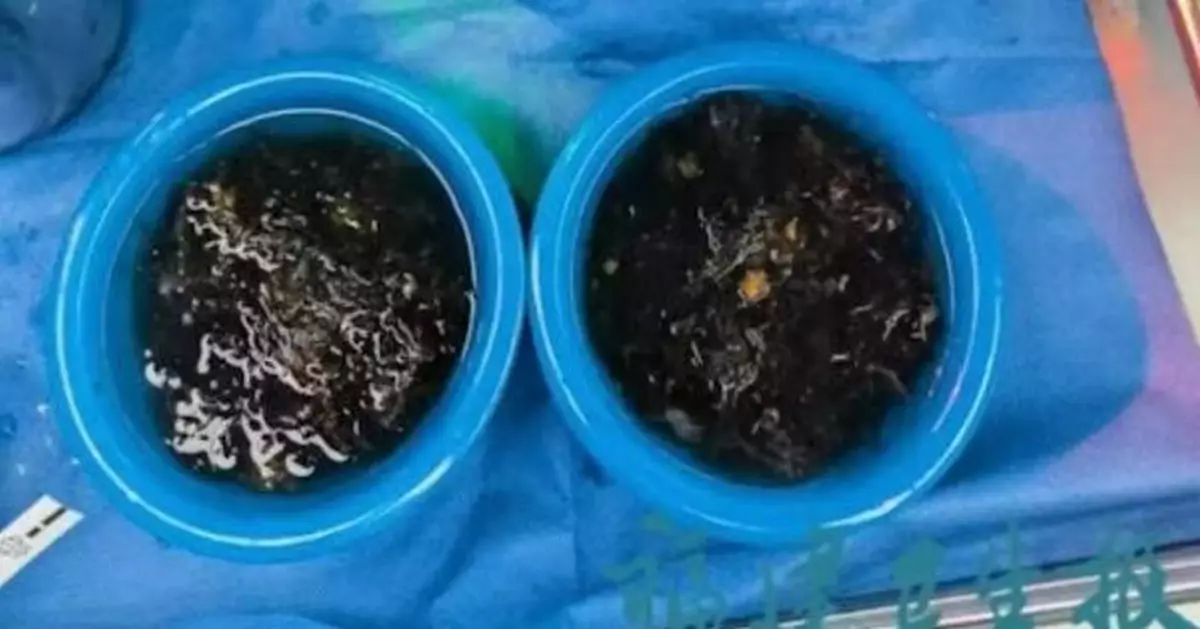 慎入！反覆肚痛3年 福建女童就醫揭患「長髮公主綜合症」 胃中取出兩大盆頭髮