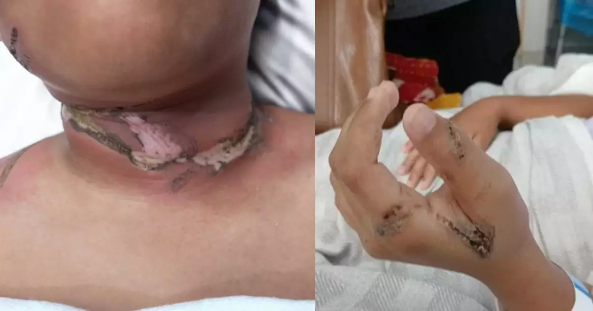 金屬頸鏈纏平板充電線短路起火 美國男童睡夢中手頸部遭嚴重燒傷