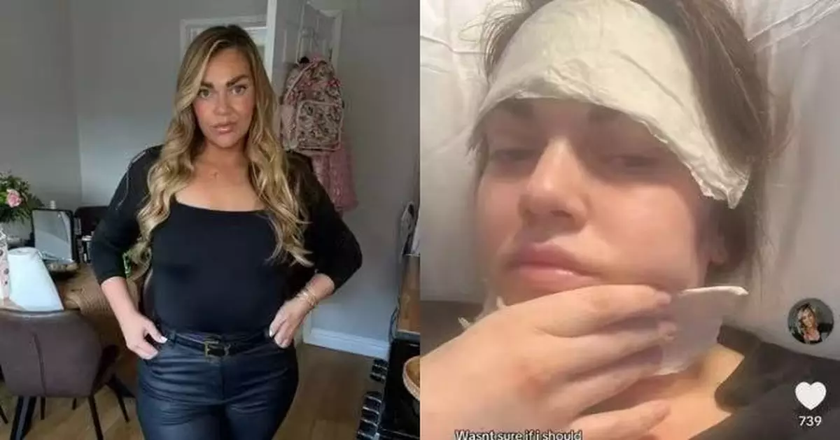 直播換半價優惠 英女貪平赴土耳其整形術後胸部爆裂染敗血症險喪命