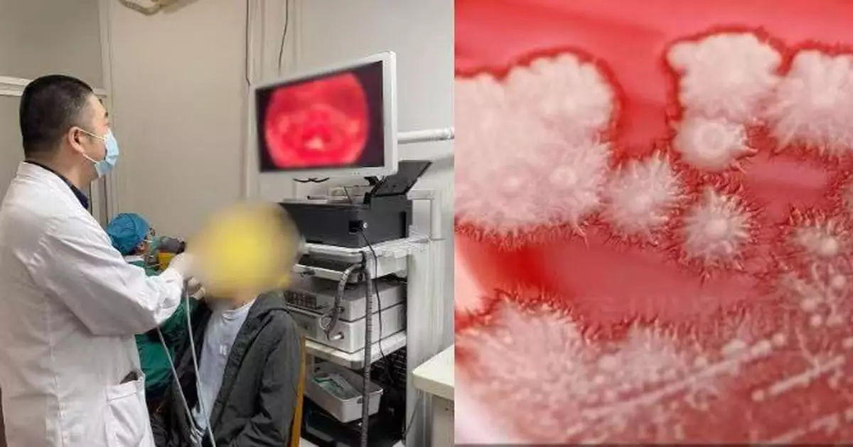 慎入！自購抗生素一感冒就服用 浙男喉嚨「長雪花」確診真菌性咽喉炎