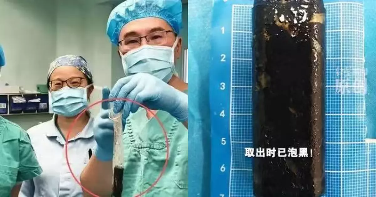 川男醉酒打賭吞打火機遺留胃內逾30年 醫生利用安全套取出已「發黑腐爛」