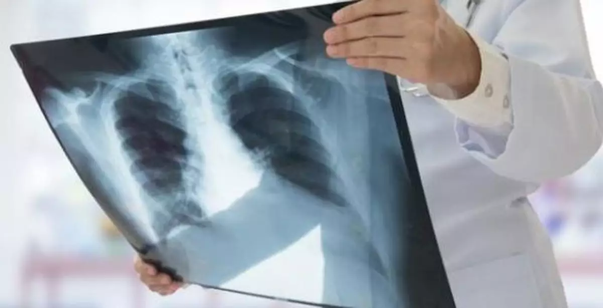 本港2023年新增癌症近38000宗 肺癌屬常見癌症第一位