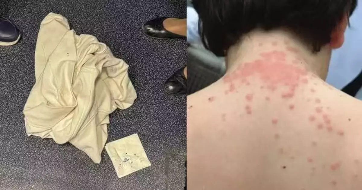 機上疑遭臭蟲叮咬 美國一家四口皮膚瘙癢紅腫怒告航空公司索賠156萬