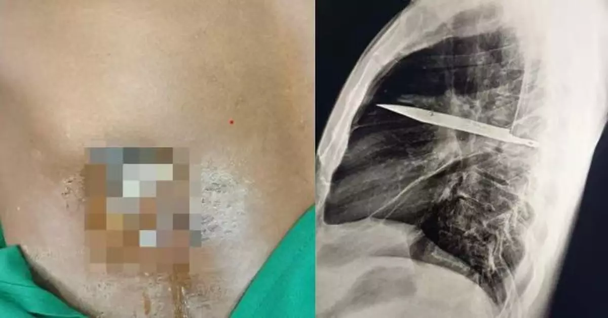 曾捲入衝突捱刀傷 坦桑尼亞男乳頭流膿就醫遭揭胸腔藏利刃8年不自知