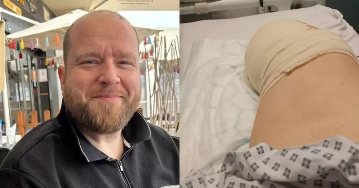 腳趾水泡久久未癒 英男就醫不足24小時感染惡化被迫截肢