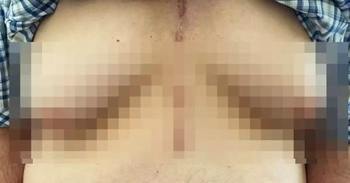 治高血壓藥暗藏副作用 美老翁服藥後乳房異常發育確診「男性女乳症」