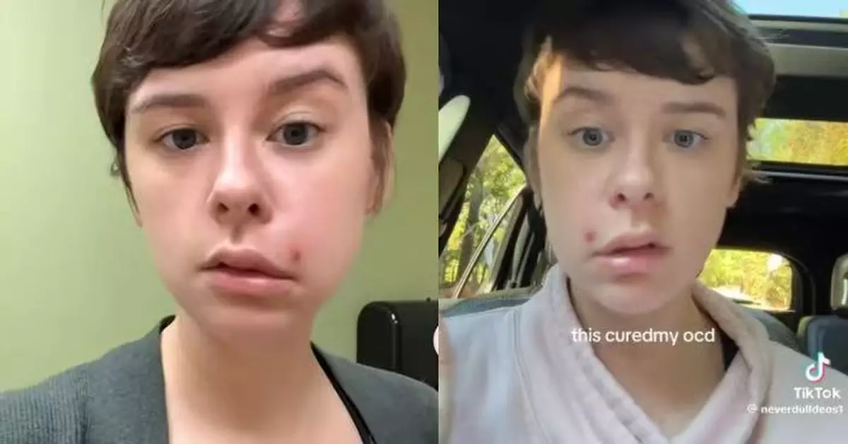 誤擠「死亡三角區」痘痘 美國女感染蜂窩性組織炎 半邊臉下垂癱瘓需住院