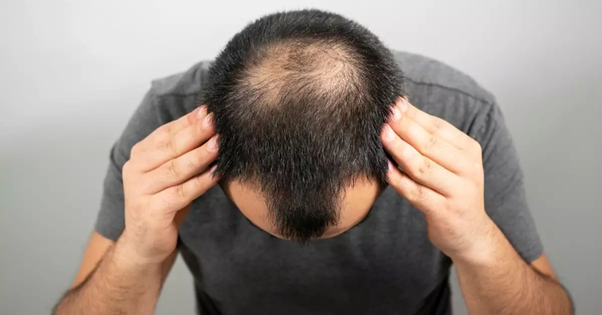 拯救光頭！南韓研議將脫髮治療納入醫保　「抗禿」概念股應聲大漲