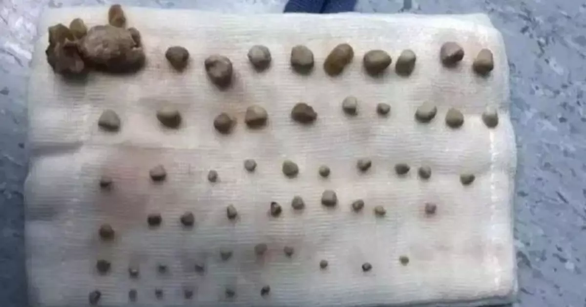 鄭州9歲童腎長56粒結石  醫生揭媽媽溺愛助養成1習慣惹禍