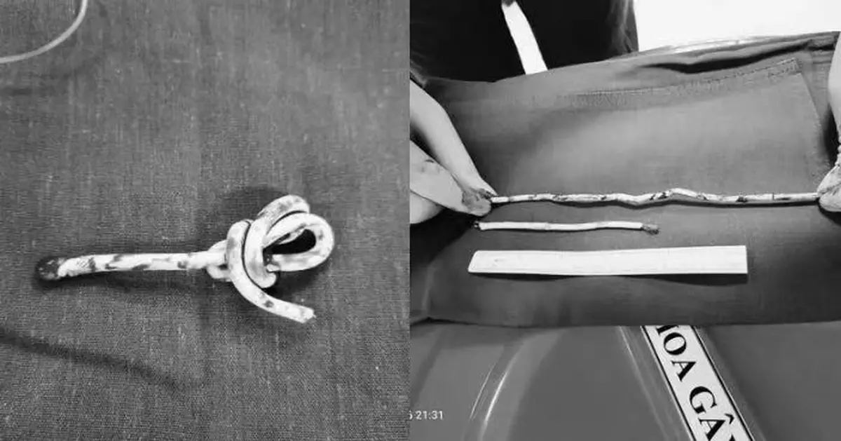 模仿網上挑戰將35CM網線塞尿道 越南少年下體劇痛腫脹急需開刀取出