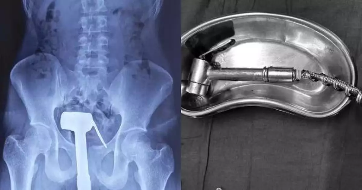 淋浴器直插肛門無法取出 印度智障男找水電工截水管後再求醫取出