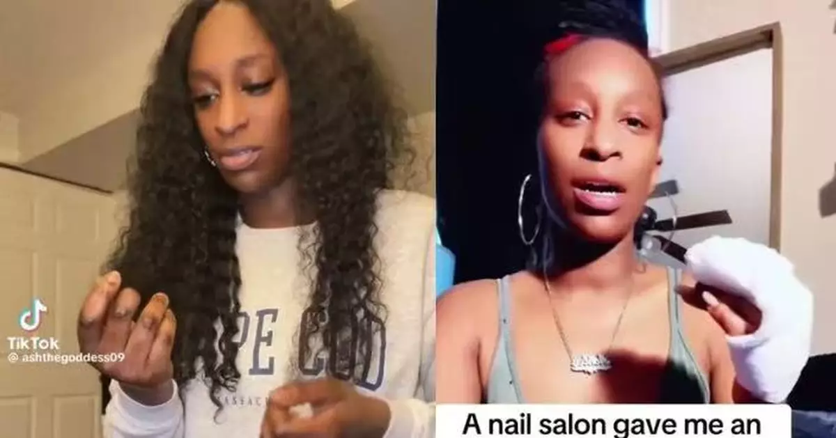 美國女美甲後手指突劇痛腫脹 就醫揭感染惡化被迫截肢 籲留意器具消毒