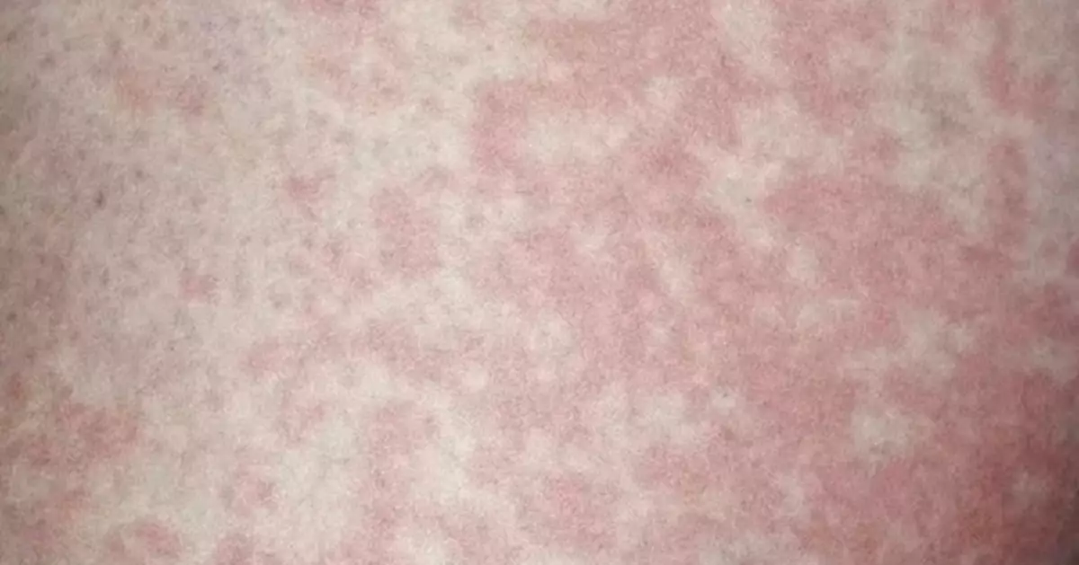 河南6旬漢大腿現紅斑就醫確診「股癬」患腳癬長期將內褲襪子混洗惹禍