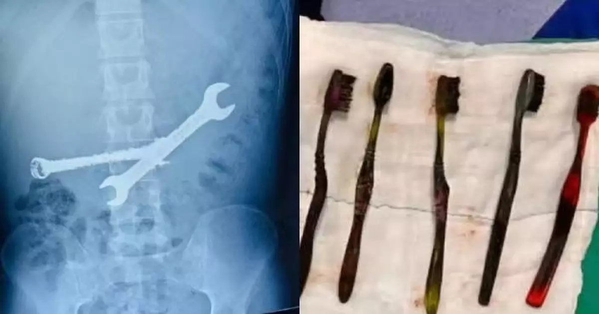 印度男腹痛就醫遭揭胃藏異物 醫護手術取出2把扳手7支牙刷感震驚