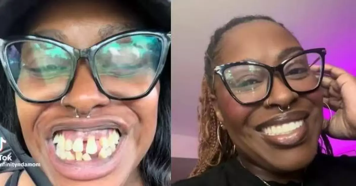 患牙周病牙齒狂脫落 美網紅飽受病痛折磨更遭網暴 全口植牙後重拾自信