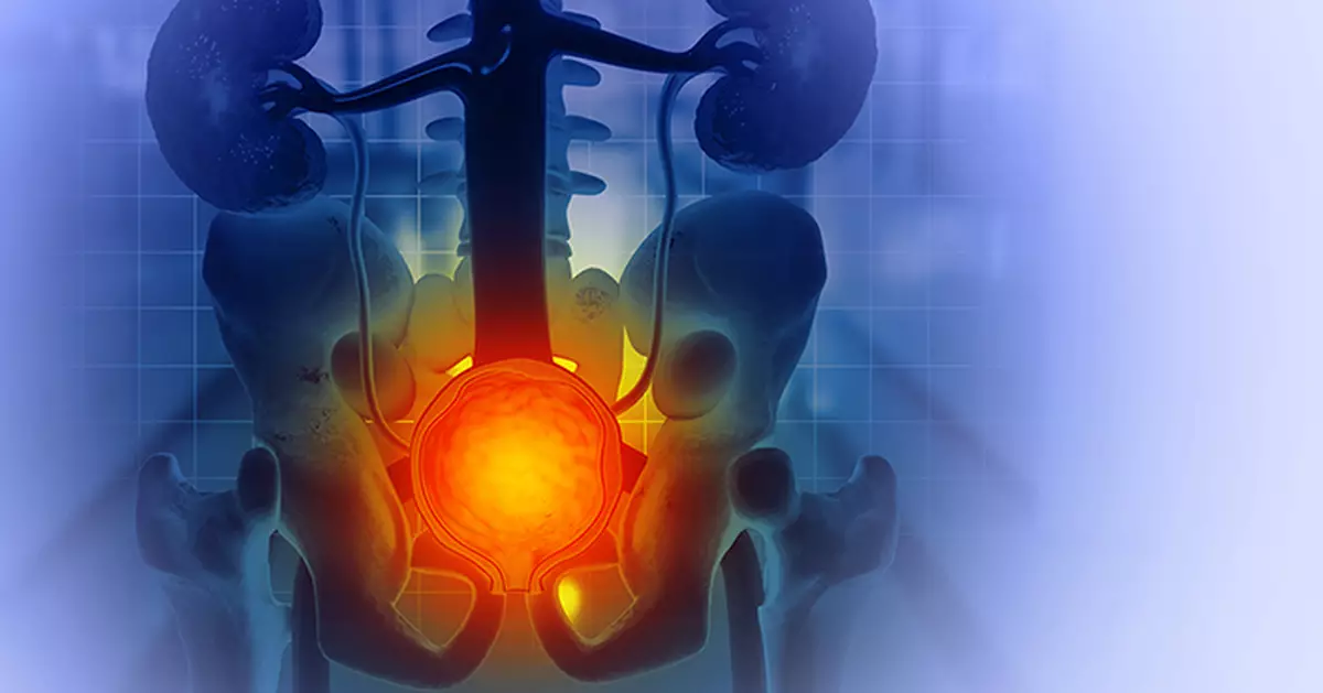 港男第三號殺手年增一成半 拆解前列腺癌「沉默」真相 必學茄紅素護養術