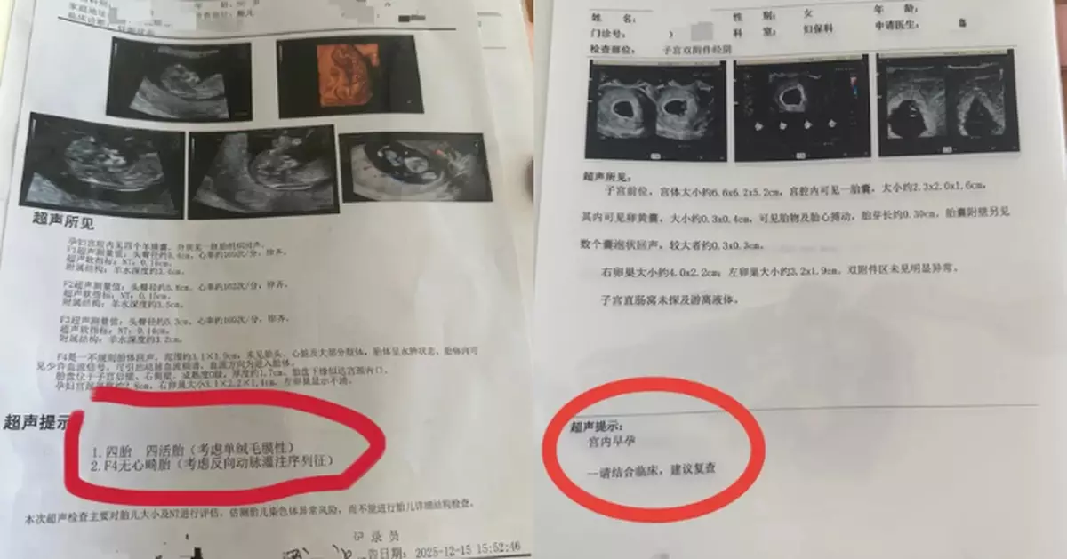 單胎變四胞胎？遼寧孕婦產檢「逐月增胎」　最後一胎竟是無心畸胎