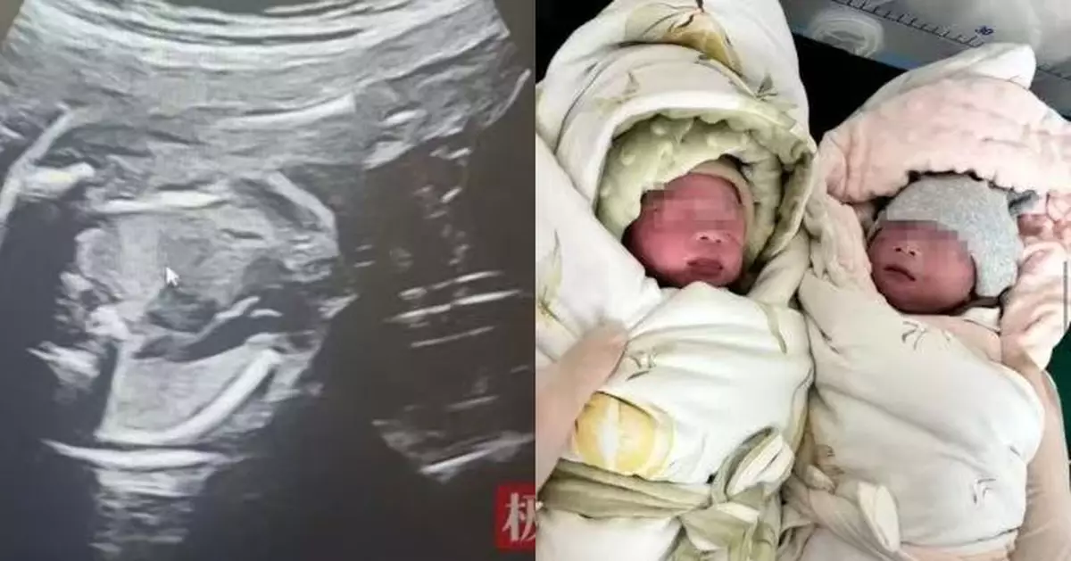 孖生仔共用胎盤「子宮內鬥」？ 湖北孕婦患雙胎輸血綜合症獲延長孕周平安分娩