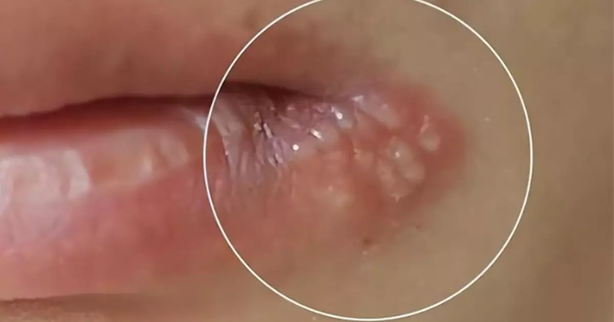 嘴角長水泡以為「爛嘴角」未及時就醫 陝西女罹皰疹性腦炎遭判腦死