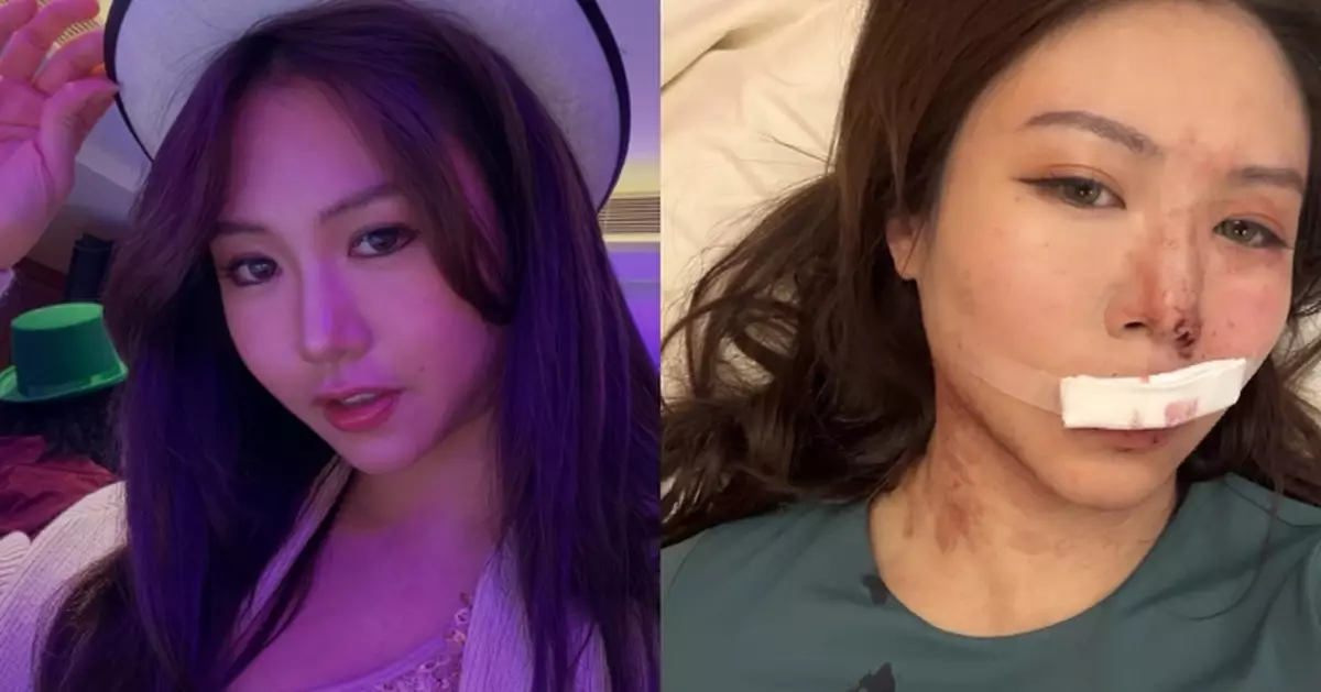 網紅Colanda地鐵突暈倒血染車廂　臉着地仆斷兩隻門牙