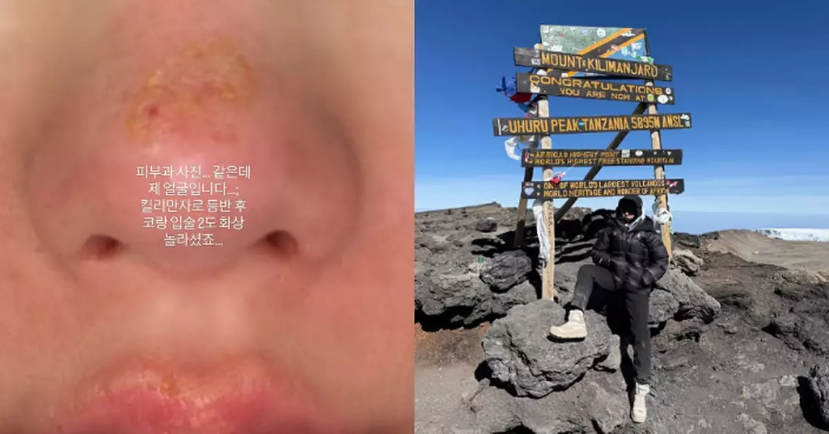 權恩妃攀登乞力馬扎羅山後臉部二度灼傷 粉絲憂心關懷