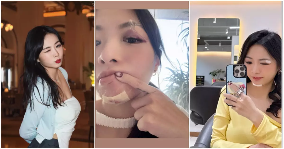 「翻版陳法拉」譚淇淇仆親撞爆面骨裂牙崩　又紅又腫惹網民關心：係咪遭家暴？