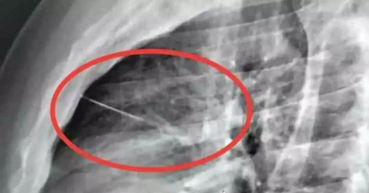 泰男躺床胸痛難耐 照X光驚揭7CM縫衣針插入胸腔險刺穿心臟