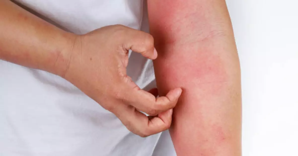 一到春天周身痕？中醫指濕氣偏重或令濕疹蕁麻疹加劇 建議辨證調理勿亂戒口