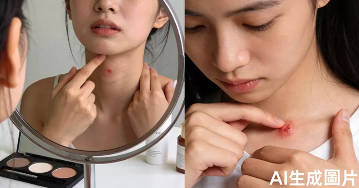 擠暗瘡感染高燒40℃ 深圳女就醫確診「2型糖尿病」 醫指1飲食習慣惹禍