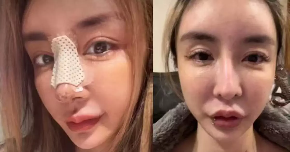 18歲起狂動刀整形 台女網紅自曝長期陷「容貌焦慮」 鼻子重整7次仍不滿意