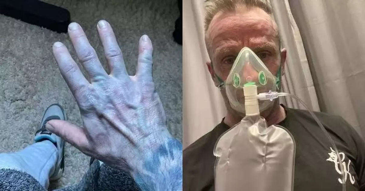 英男突全身變藍成「阿凡達」 友人以為患重病急送院 揭爆笑烏龍真相