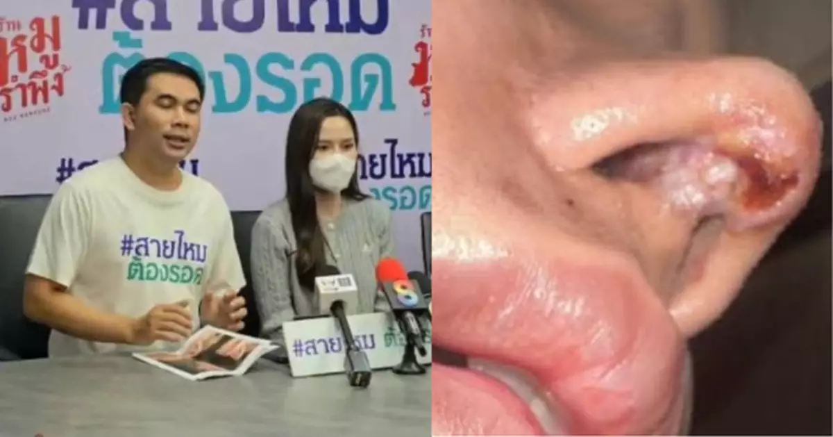 花10萬隆鼻修復 泰女網紅術後鼻部發炎疑壞死凹陷求全額退款